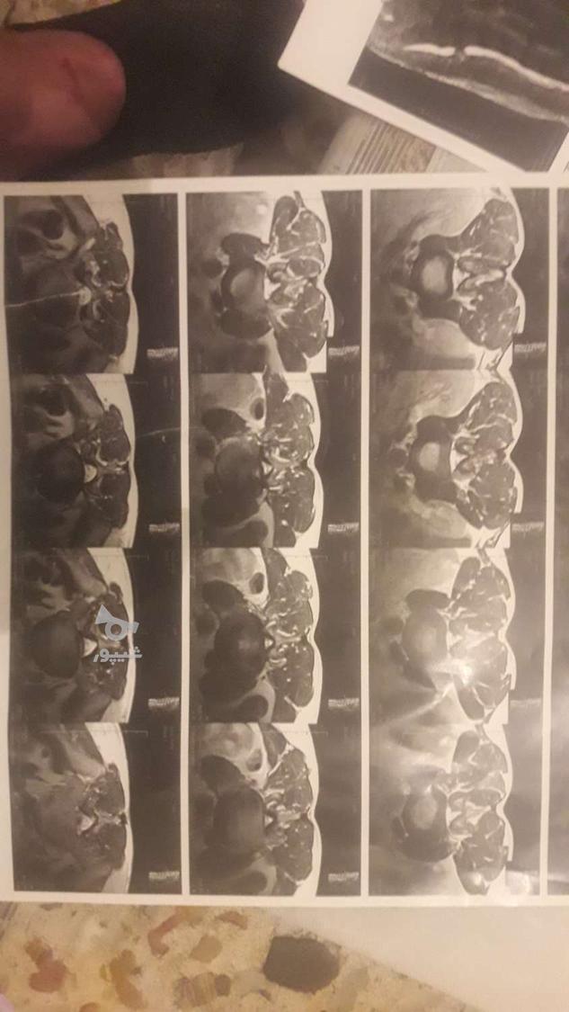 شکسته بندی سنتی استادحکیم