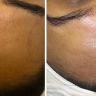 فیشال و پاکسازی پوست اقایون و خانم ها در مشهد تحت نظر پزشک