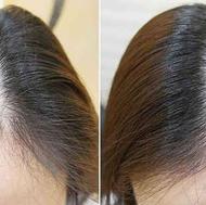 درمان ریزش مو