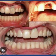 کشیدن دندان های قدامی هشت (8)دندان جلو