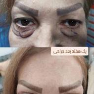 جراحی پلک بلفارو پلاستی لیفت شقیقه