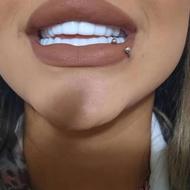 لمینت متحرک دندان