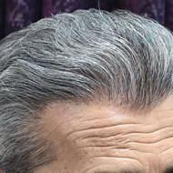 کاشت مو پول نمیخاد