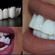 لمینت متحرک دندان