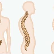 مرکز درمانی و تخصصی اصلاح قوز، گودی کمر، انحراف لگن