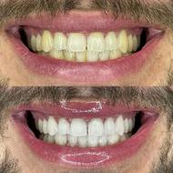 بلیچینگ فکی 5 تومان (مواد آلمانی)