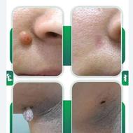 برداشت خال و لک زگیل تضمینی