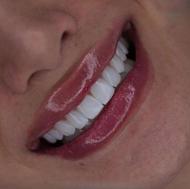 انجام کامپوزیت و رفع افتادگی پلک بالا