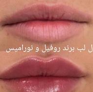 تخفیف 50 درصد ژل گونه و لب ، چانه برند روفیل