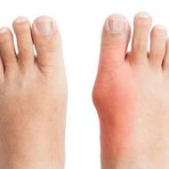 مرکز ارتوپدی درمان هالوکس والگوس (شصت پای کج)