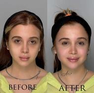 تزریق ژل و بوتاکس با سیسی 1 تومن