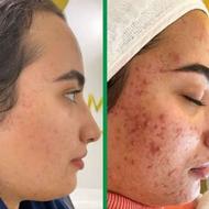 پک ضد جوش والتهاب پوست