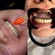 اوردنچر هر فک 74 میلیون/ ایمپلنت/ دندانپزشکی