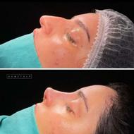 جراحی زیبایی بینی