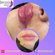 بوتاکس مصپورت 800هزار تومن فول فیس بشرط اصالت و کیفیت