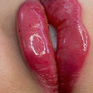 بوتاکس وفیلر وفیلر بادی