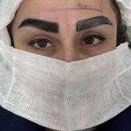 کاشت مو و ابرو در کم ترین تایم و بهترین تراکم