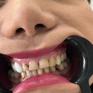 زیبایی دندان های شما در یک جلسه