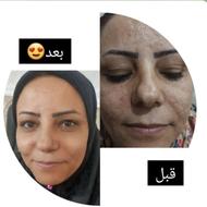 رفع لک ، جوش ، آکنه ، منافذ باز پوستی و ...