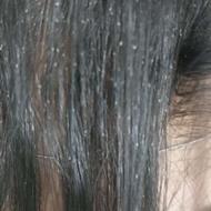 محلول درمان شپش در یک جلسه 