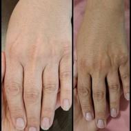 جوانسازی دست