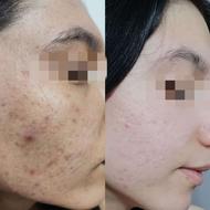 رفع لک جوش جای جوش آکنه منافذ باز پوستی و...