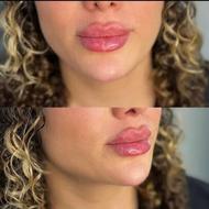 جشنواره تخفیف ژل وبوتاکس وکانتورینگ کامل صورت