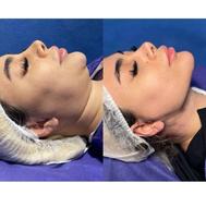 ابداع کننده سوپر کانتورینگ وی لاین در ساکشن غبغب