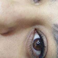 مدل کاشت هیدن