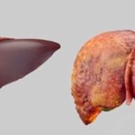 پاکسازی کبد چرب