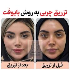 تزریق چربی (بایوفت)