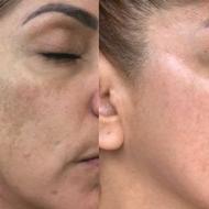 درمان لک بدون بازگشت