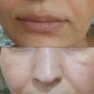 رفع لک جوش جای جوش آکنه منافذ پوستی و ...