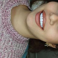 دندانپزشکی الماس روکش کامپوزیت عصب کشی سطحی