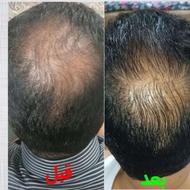پک کامل ریزش مو و رویش مجدد مو