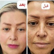 درمان انواع لک جوش جای جوش آکنه منافذ پوستی و ...