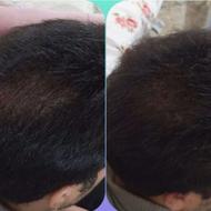 پک ضد ریزش و رویش مجدد