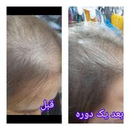 پک رفع ریزش مو و رویش مجدد