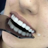 کامپوزیت دندان