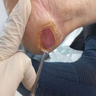 کارشناس زخم