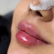 تزریق ژل بوتاکس