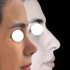 جراحی بینی با تخفیف ویژه زمستانه توسط متخصص