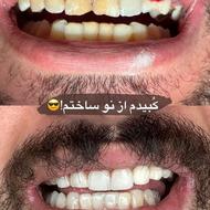 پکیج عصب کشی فقط6500