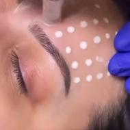 تزریق بوتاکس ژل لب کانتورینگ صورت فیشیال