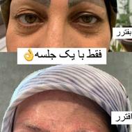 لیزر پاک کردن تتو ،کربن تراپی،روشن سازی نواحی تیره