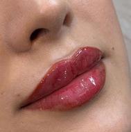 تزریق فیلر صورت و بوتاکس