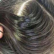 درمان شپش 100٪