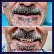 جشنواره ایمپلنت اقساطی