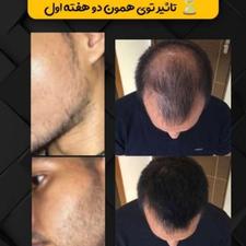 برای درمان قطعی ریزش مو