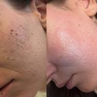 فیشال تخصصی بادستگاه وپاکسازی عمیق